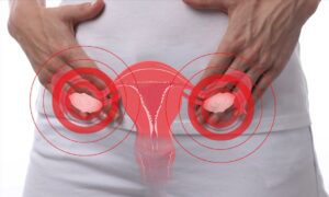 Primera línea de actuación en el síndrome de ovarios poliquísticos: el estilo de vida