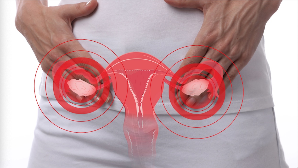 Primera línea de actuación en el síndrome de ovarios poliquísticos: el estilo de vida